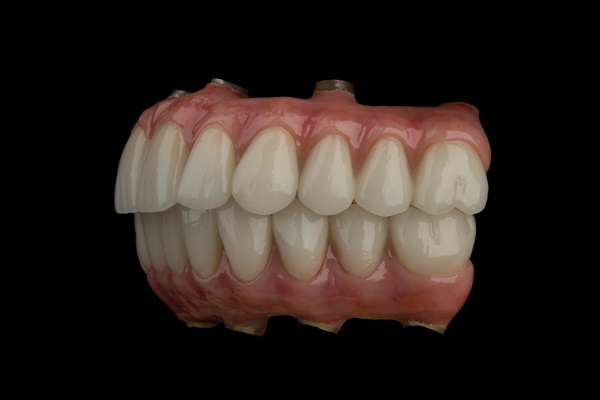 Can All On   Replace Multiple Teeth?