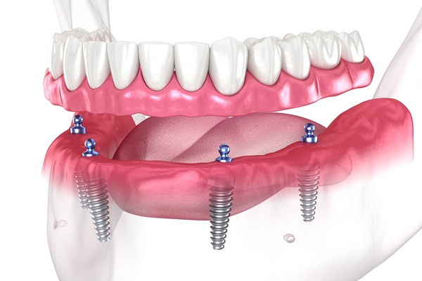 All On   Can Replace Multiple Missing Teeth