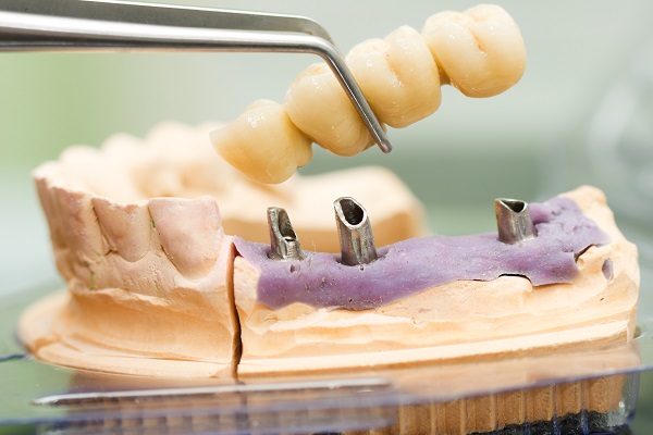 Replace Your Missing Teeth With A Dental Bridge